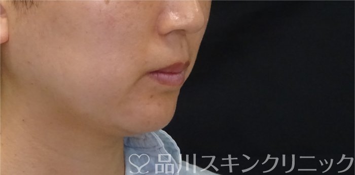 症例NO.72063のBEFORE写真