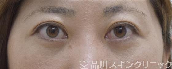 症例NO.52520のAFTER写真