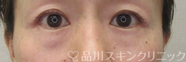 症例NO.69910のBEFORE写真