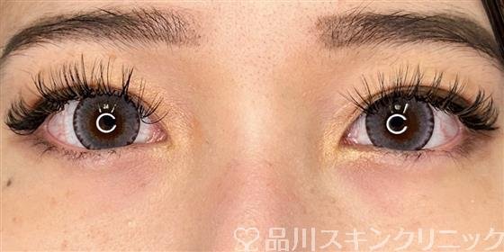 症例NO.59351のAFTER写真
