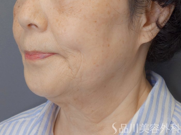 症例NO.71810のBEFORE写真