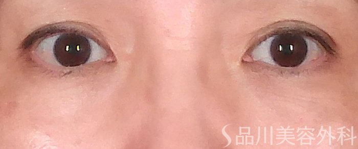 症例NO.70709のAFTER写真
