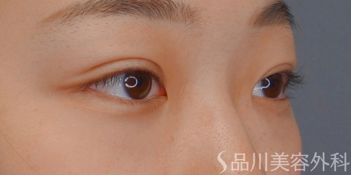 症例NO.74315のAFTER写真