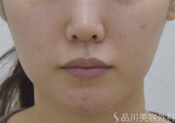 症例NO.44615のBEFORE写真