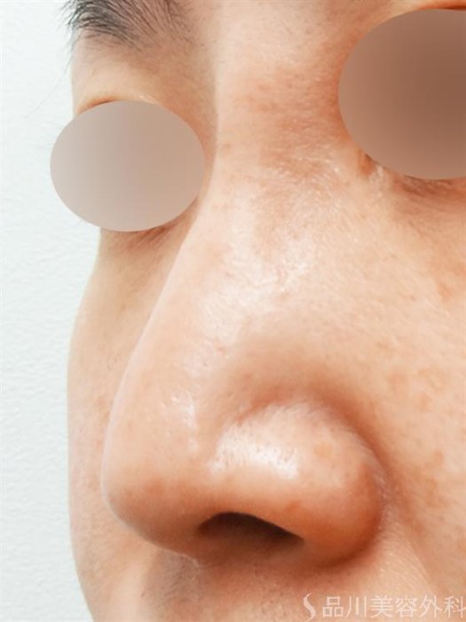 症例NO.27504のBEFORE写真