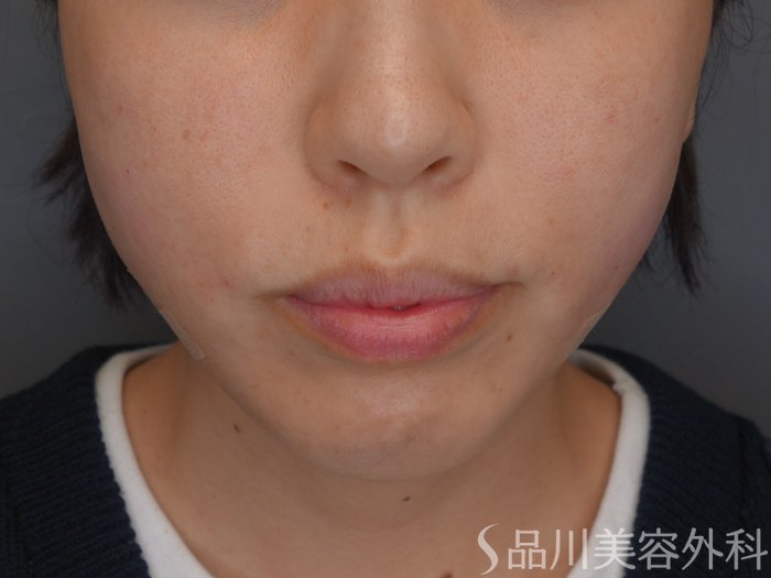 症例NO.67706のAFTER写真