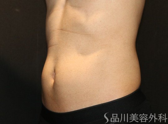 症例NO.70324のAFTER写真