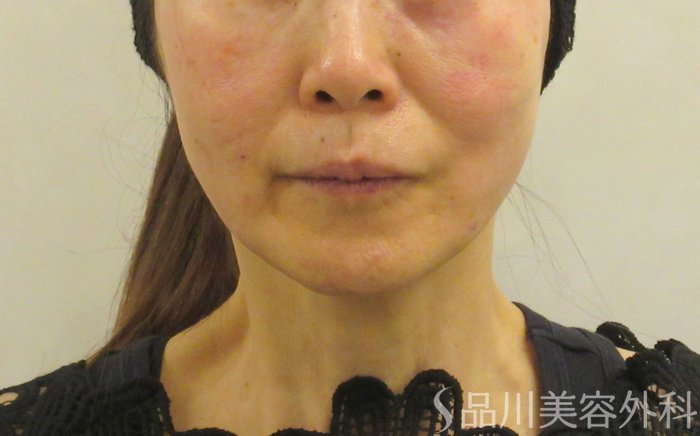 症例NO.73499のAFTER写真