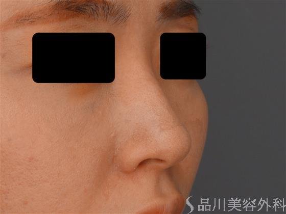 症例NO.60023のBEFORE写真