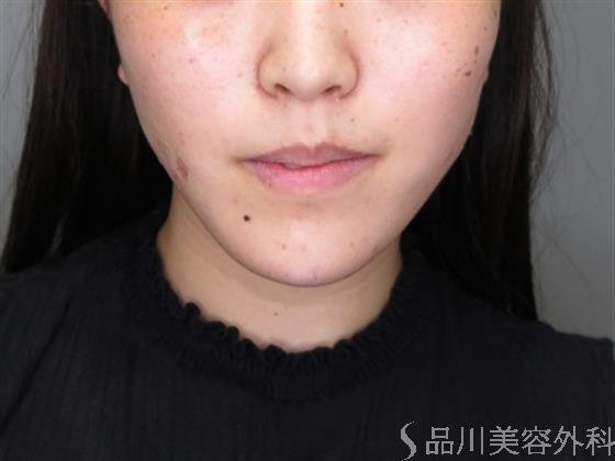 症例NO.48388のAFTER写真