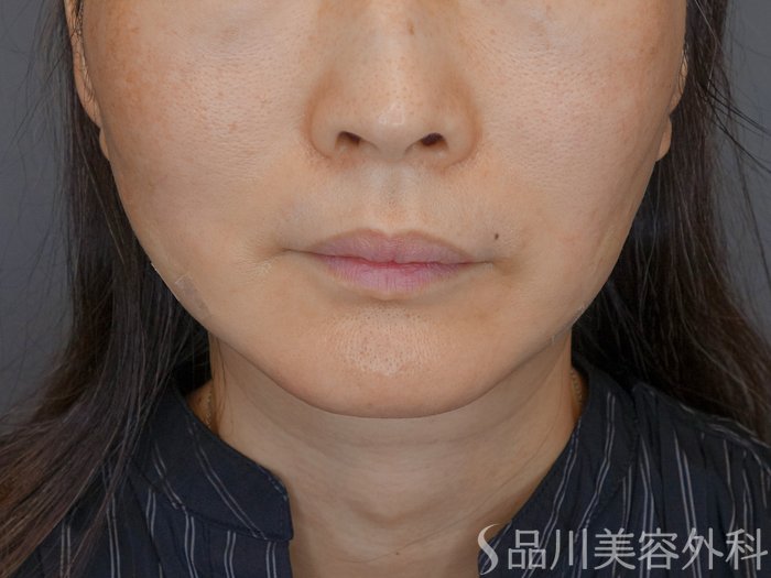 症例NO.72079のAFTER写真