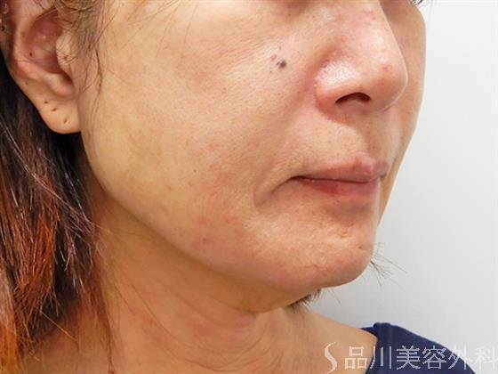 症例NO.54191のBEFORE写真