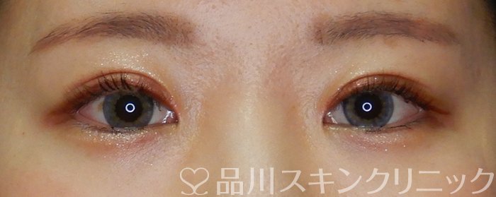 症例NO.63913のAFTER写真