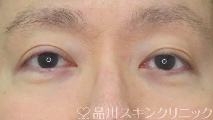症例NO.70390のAFTER写真