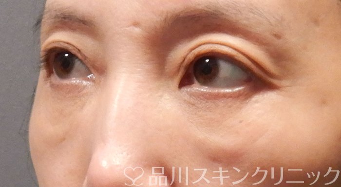 症例NO.70660のBEFORE写真