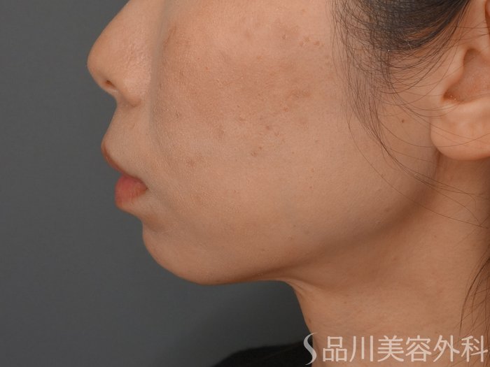 症例NO.74476のBEFORE写真