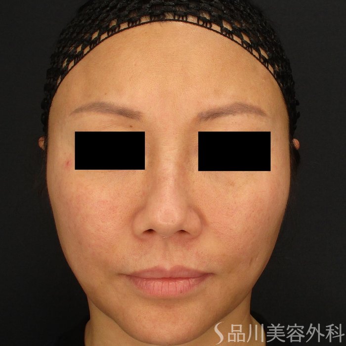 症例NO.65281のBEFORE写真