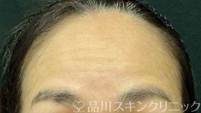 症例NO.74854のBEFORE写真