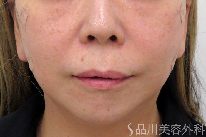 症例NO.74160のAFTER写真