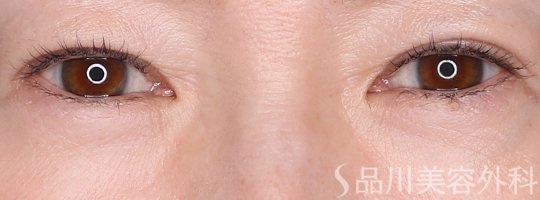 症例NO.72136のAFTER写真