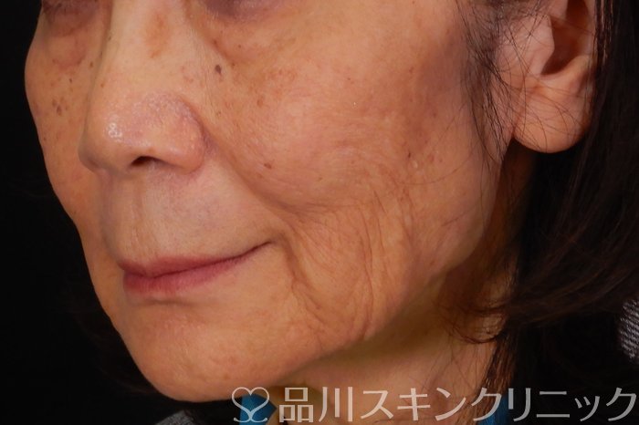 症例NO.65184のBEFORE写真