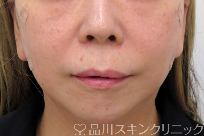 症例NO.74160のAFTER写真