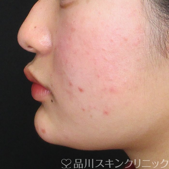 症例NO.72692のAFTER写真