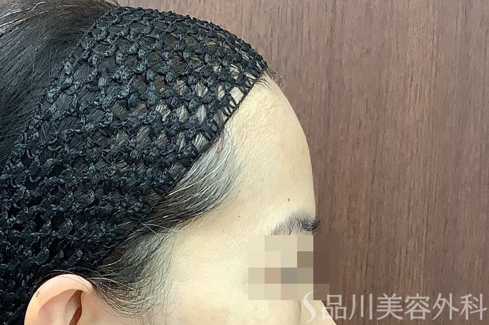 症例NO.67780のBEFORE写真