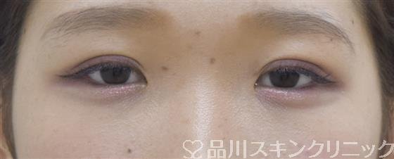 症例NO.44506のAFTER写真