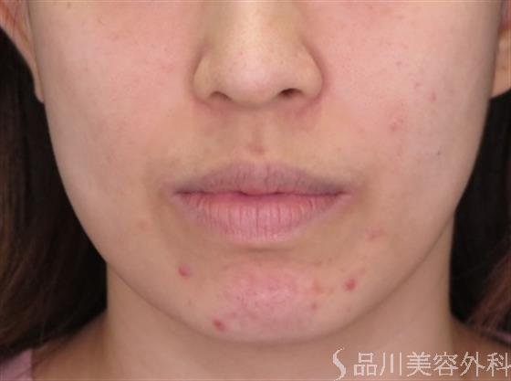症例NO.47524のBEFORE写真