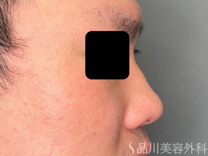 症例NO.74469のBEFORE写真