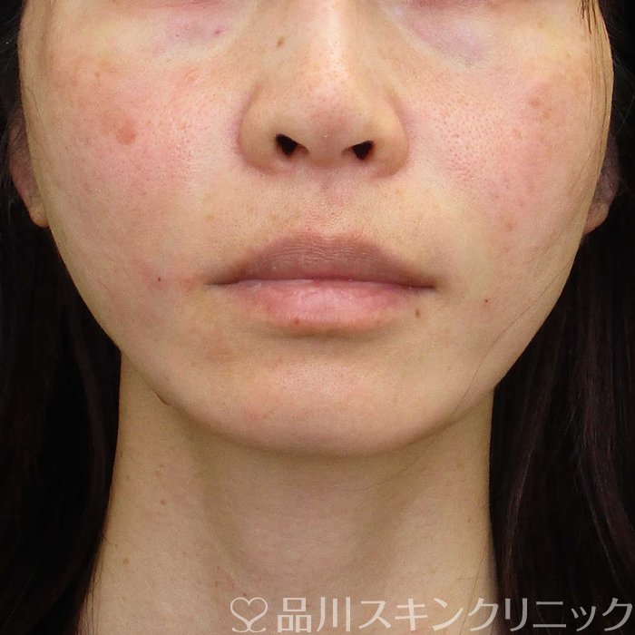 症例NO.65479のAFTER写真