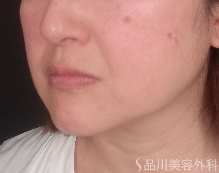 症例NO.70612のBEFORE写真