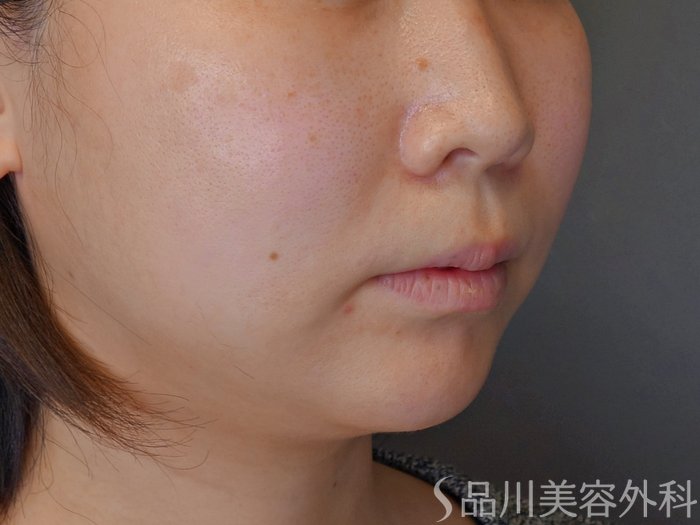 症例NO.73307のBEFORE写真