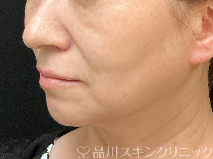 症例NO.74852のBEFORE写真