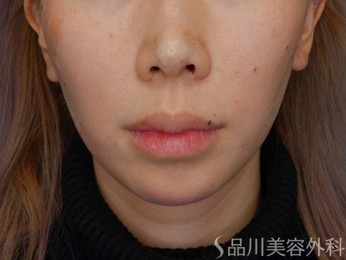 症例NO.72986のAFTER写真