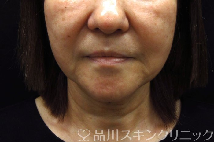 症例NO.74558のBEFORE写真