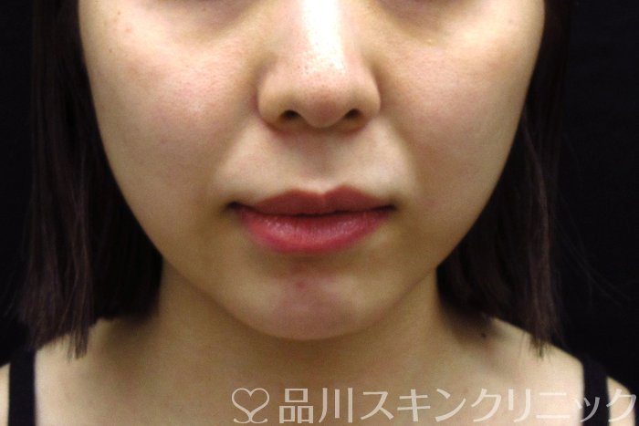 症例NO.74362のBEFORE写真