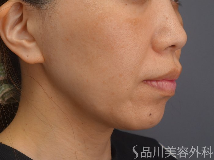 症例NO.75289のBEFORE写真