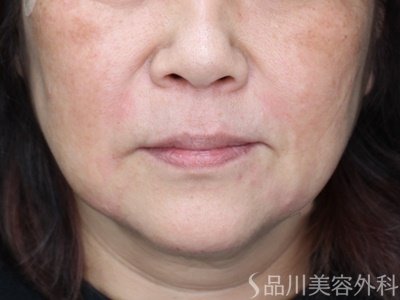 症例NO.72392のAFTER写真