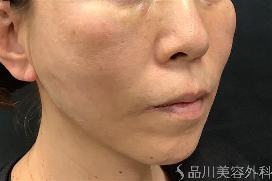 症例NO.60646のAFTER写真