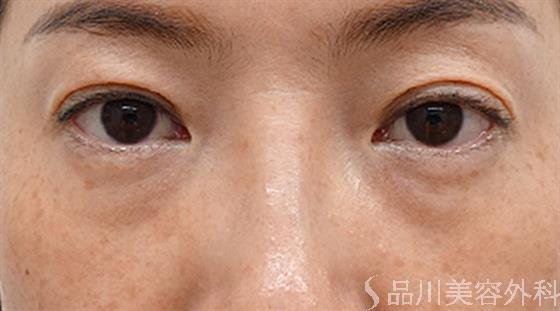 症例NO.47778のBEFORE写真