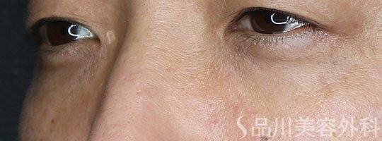 症例NO.72378のAFTER写真