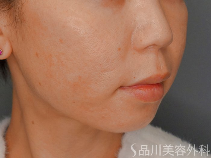 症例NO.73246のAFTER写真