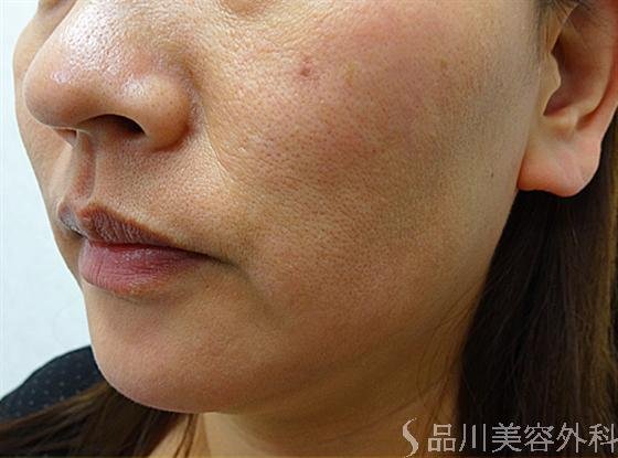 症例NO.14156のBEFORE写真