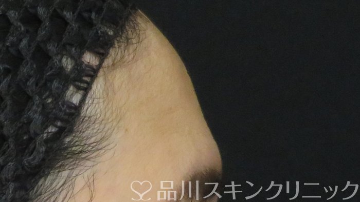 症例NO.72293のBEFORE写真