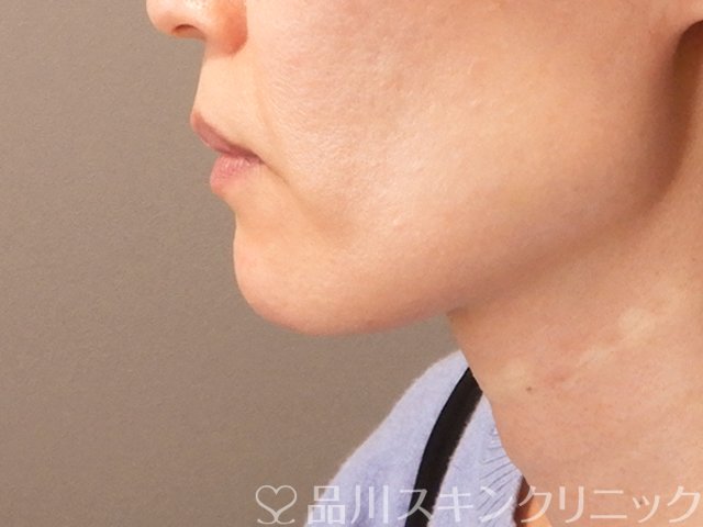症例NO.70676のAFTER写真