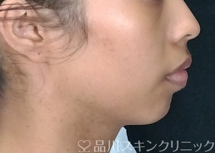 症例NO.70921のBEFORE写真