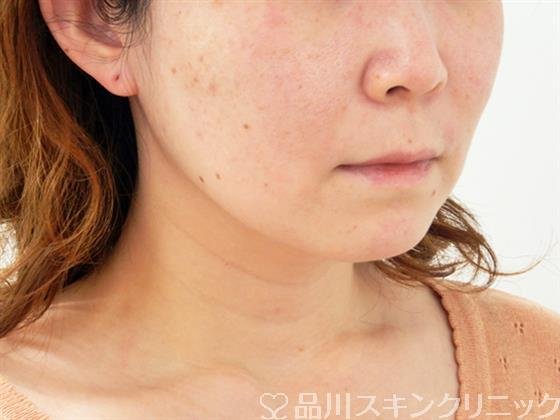 症例NO.53087のBEFORE写真