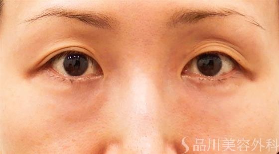 症例NO.61092のBEFORE写真